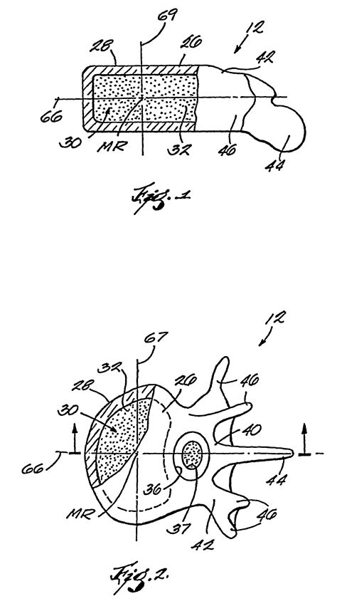 Patent Us8034071 Systems And Methods For Forming A Cavity In