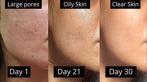 Damaged Skin Repair Close Large Open Pores In 30 Days Oily Skin