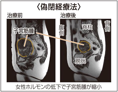 【コンビニ受取対応商品】 子宮筋腫 検査から診断 最新の治療法まで br