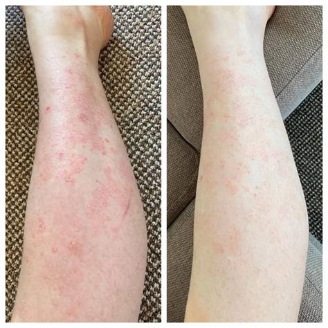Psoriasis Before And After Treatment Pictures