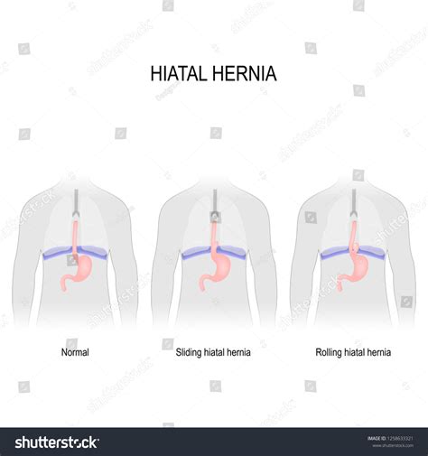 Hiatal Hernia Vector Diagram Different Types Vector De Stock Libre De
