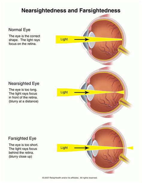 Astigmatisme Betekenis Astigmatism Glaucoma Swollen Eyes Disease My
