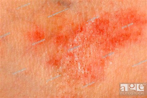 Allergic Rash Dermatitis Skin Stock Photo Picture And Low Budget