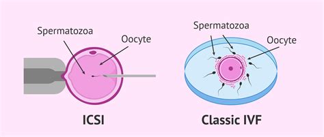 Difference Between Classic Ivf And Icsi