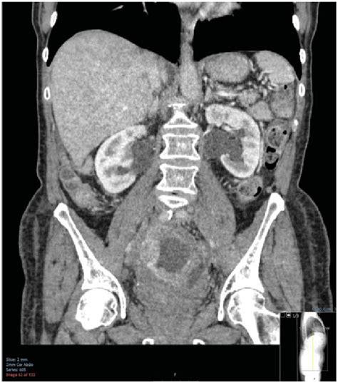 Ct Scan Of The Abdomen And Pelvis Showing The Large Carcinoid Tumor And