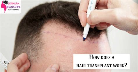 How Does A Hair Transplant Work Sab Clinic