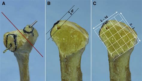 Can Anatomic Posterolateral Corner Reconstruction Using A Fibular