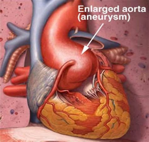 Enlarged Aorta Symptoms Treatment Surgery Pictures Hubpages