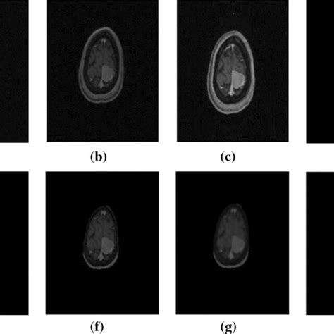 Non Tumored Brain Mri Sample Images A Normalization Of Brain Mri