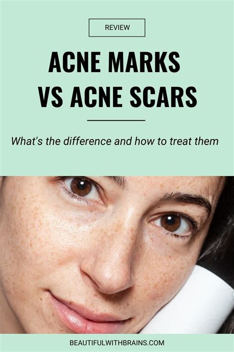 Acne Marks Vs Acne Scars Difference Causes And Treatments