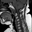 Rheumatoid arthritis of cervical spine | Image | Radiopaedia.org