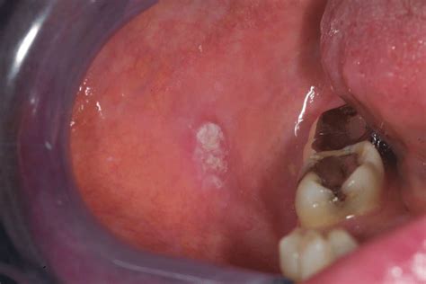 Right Buccal Mucosa Squamous Cell Carcinoma Case 3 Download