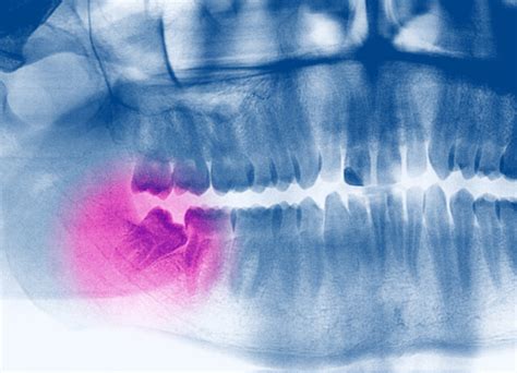 Broken Wisdom Tooth Dr Gibberman Center For Esthetic Dentistry