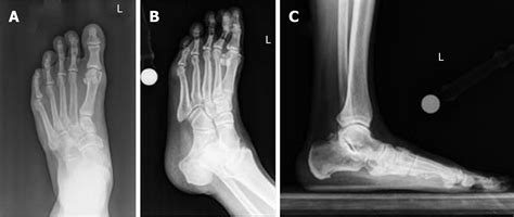 Osteoarthritis Of The Ankle