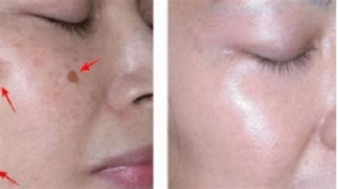 Rawatan untuk luka di muka perlu diteruskan dengan konsisten agar proses untuk sembuh dapat dicapai dalam jangka masa yang lebih cepat. Bintik Hitam di Wajah - Cara Hilangkan Bintik Hitam