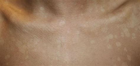 How To Stop Itching From Tanning Bed Best Pasties