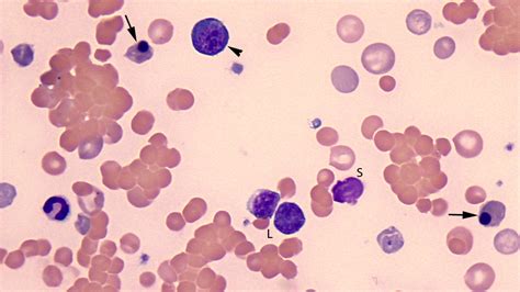 Blood From A Dog With Immune Mediated Hemolytic Anemia