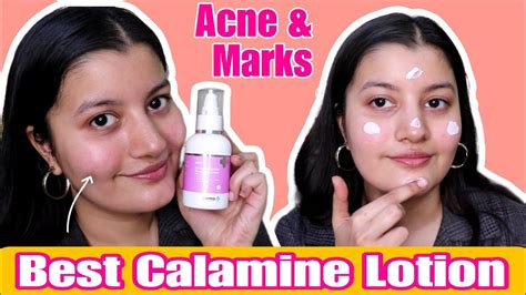Calamine Lotion Acne