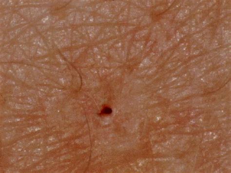 Microscopic View Of A Human Pore Normal Body Microscopic Pore Human