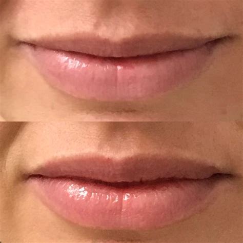 lip flip botox before and after photos
