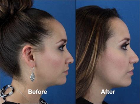 Check spelling or type a new query. Kybella double chin reduction is changing the way we look ...