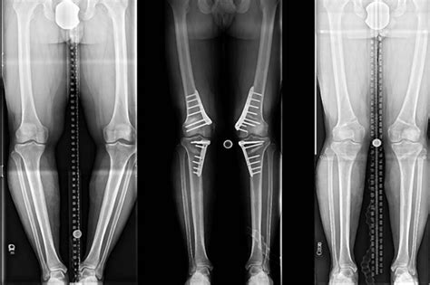 High Tibial Osteotomy And Leg Corrective Deformities Dr Mardini Academy