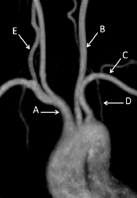 Magnetic Resonance Angiogram Of The Aortic Arch The Bmj