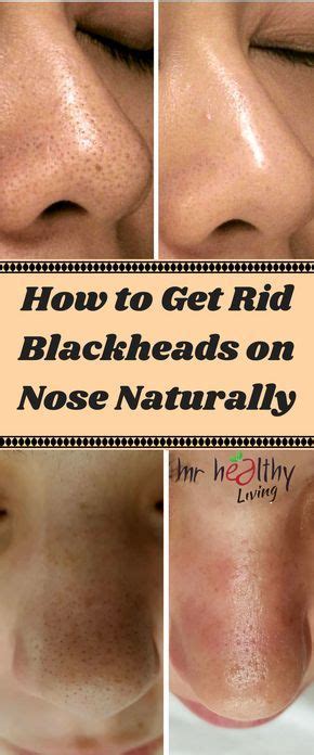How to let your scab heal properly. Eliminate Wrinkles and Blackheads in less than a week with ...