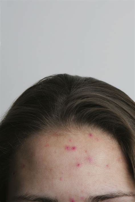 How Hormones Cause Your Acne