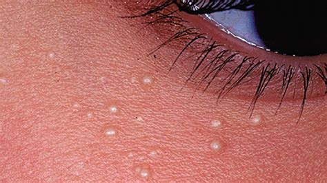 White Spots On Skin Tips On Dealing With White Spots Naturally