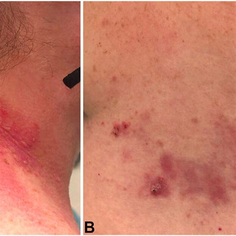 Clinical Image Of Well Demarcated Erythematous Plaques With Erosions