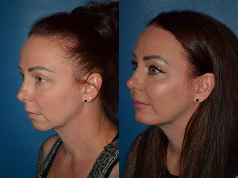 Before And After Chin Augmentation Photos Dr Miguel