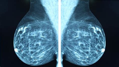 Do You Have Dense Breast Tissue What Does It Mean