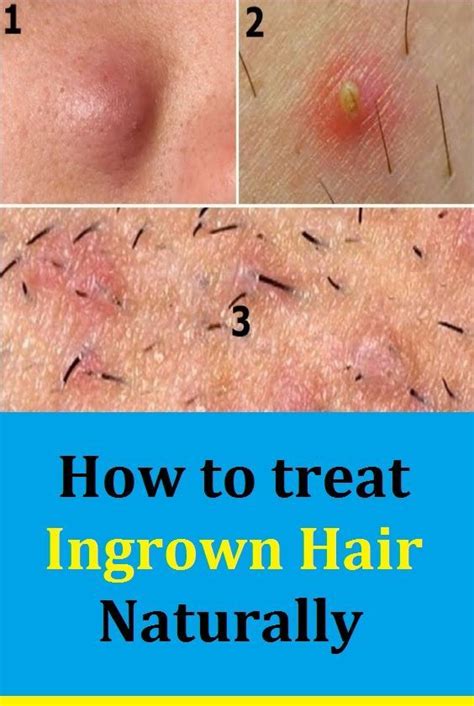 How To Treat Ingrown Hair Naturally In Ingrown Hair Treat