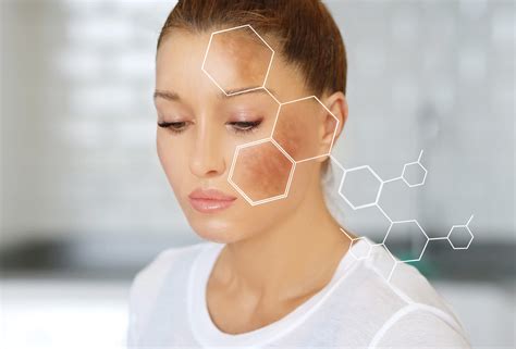 Chemical Peels For Treating Hyperpigmentation The Professionals View