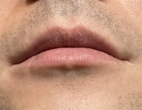 Personal Fordyce Spots On Upper Lip Rskincareaddiction