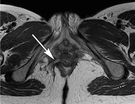 Imaging Of Acute Conditions Of The Perineum Radiographics