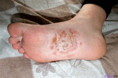 Dyshidrotic Eczema Feet Treatment