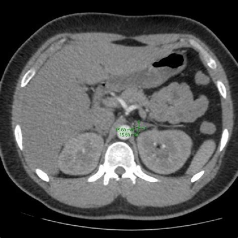 Ct Scan Of Abdomen Showing Hyperplastic Lateral Limb Of The Left