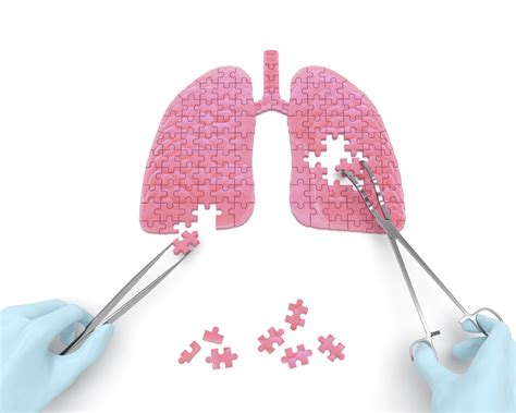 Bronchiectasis In Kartagener Syndrome Patient Treated Successfully With