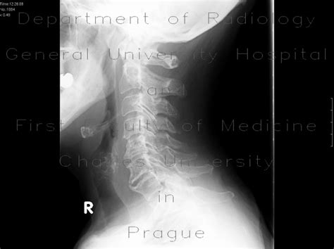 Radiology Case Degenerative Changes Of The Cervical Spine