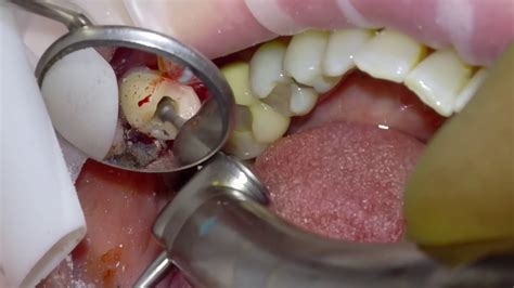 Removal Of A Broken Tooth And Immediate Placement And Loading Of A Dental Implant Youtube