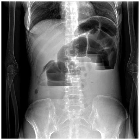 Intestinal Obstruction X Ray Approach To The Abdominal X Ray Axr Undergraduate That