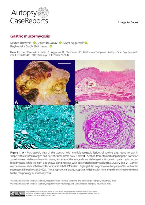Pdf Gastric Mucormycosis