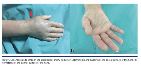 Hand Hematoma After Cardiac Catheterization Via Distal Radial Artery