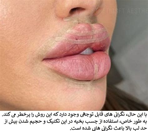 Expert Warns Against Butterfly Lips Filler Trend