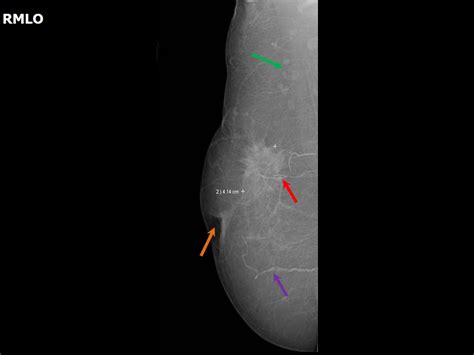 Atlas Of Breast Cancer Early Detection