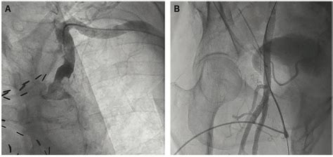 Femoral Hemostasis When To Avoid A Vascular Closure Device