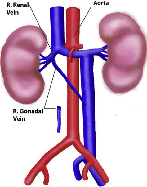 Figure From Right Gonadal Vein Transposition For The Treatment Of