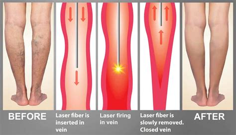 Endovenous Laser Ablation Pittsburgh Vein Doctor Varicose Vein Center